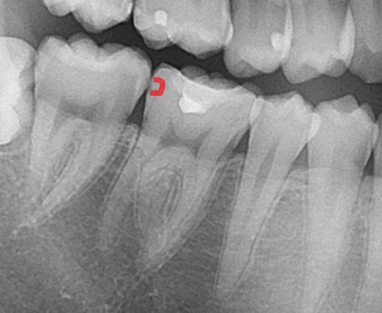 ダイレクトボンディング　虫歯　歯医者　自由が丘