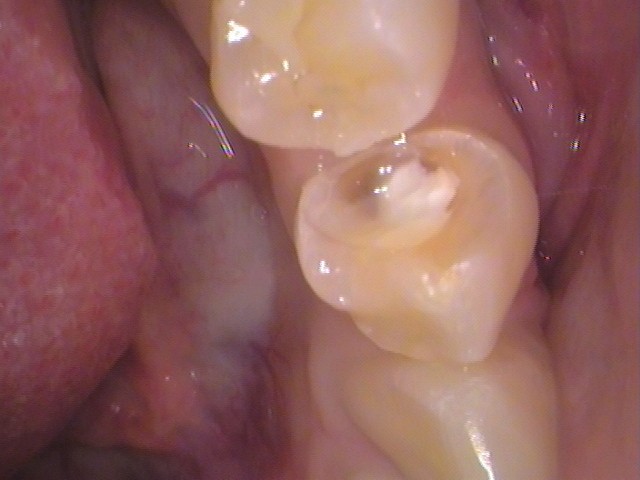 レジン　虫歯　セラミック治療　歯医者　自由が丘