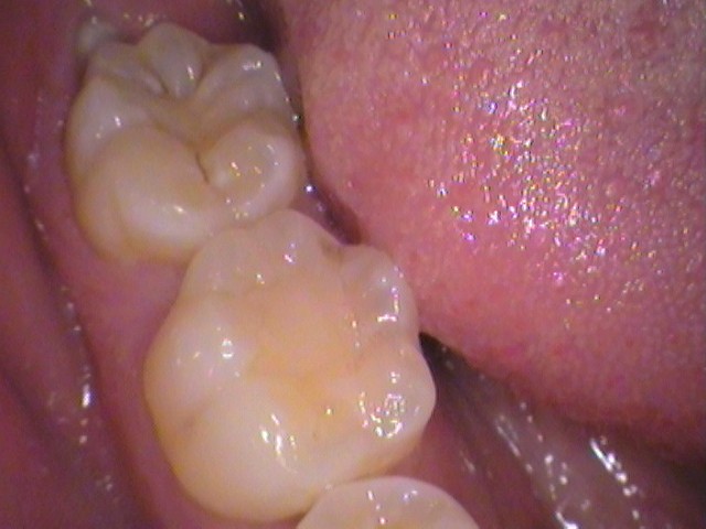 ダイレクトボンディング　虫歯　歯医者　自由が丘