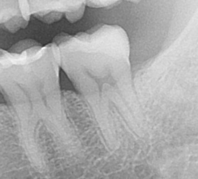 銀歯　虫歯　歯が欠けた　自由が丘　歯医者