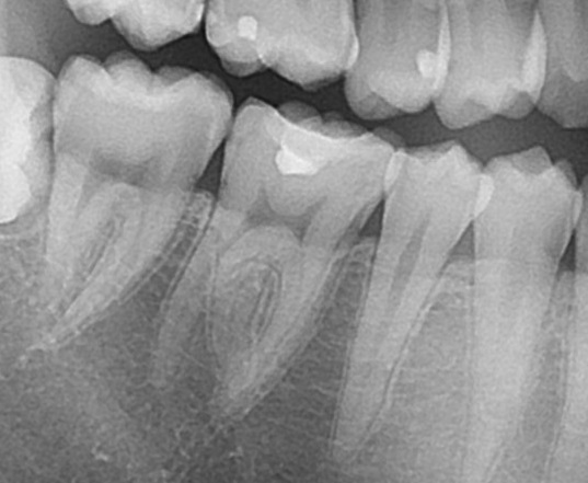ダイレクトボンディング　虫歯　歯医者　自由が丘