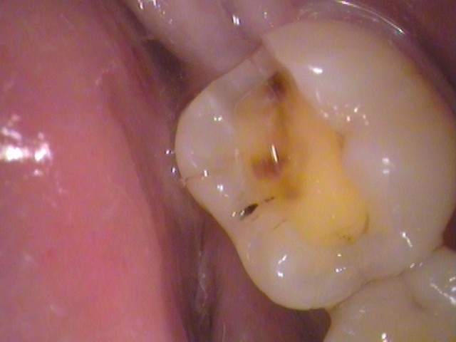 銀歯　虫歯　歯が欠けた　自由が丘　歯医者