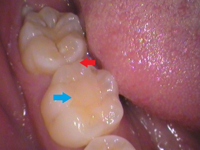 ダイレクトボンディング　虫歯　歯医者　自由が丘