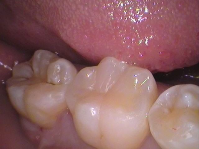 ダイレクトボンディング　虫歯　歯医者　自由が丘