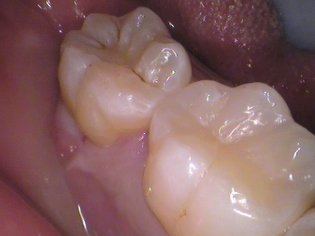 ダイレクトボンディング　虫歯　歯医者　自由が丘