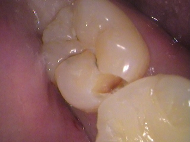 歯の黒い線　虫歯　セラミック　歯医者　自由が丘