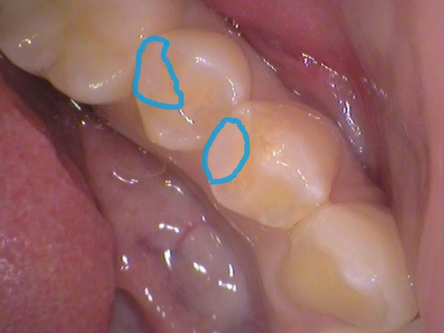レジン　虫歯　セラミック治療　歯医者　自由が丘