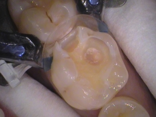 ダイレクトボンディング　虫歯　歯医者　自由が丘