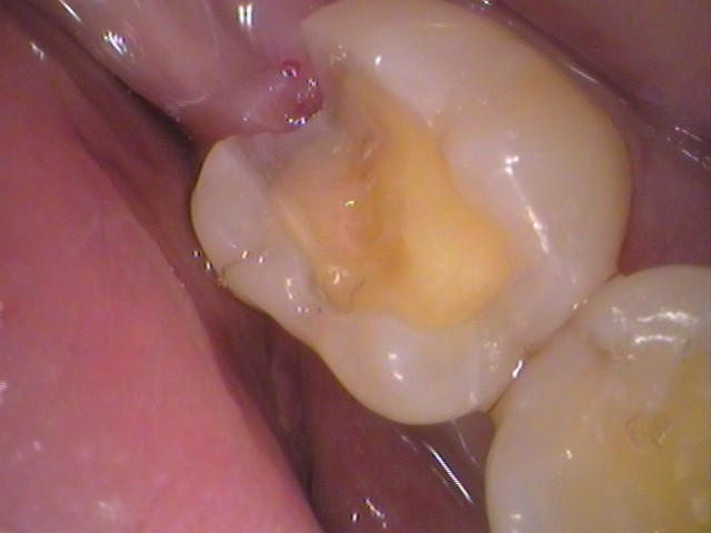 銀歯　虫歯　歯が欠けた　自由が丘　歯医者