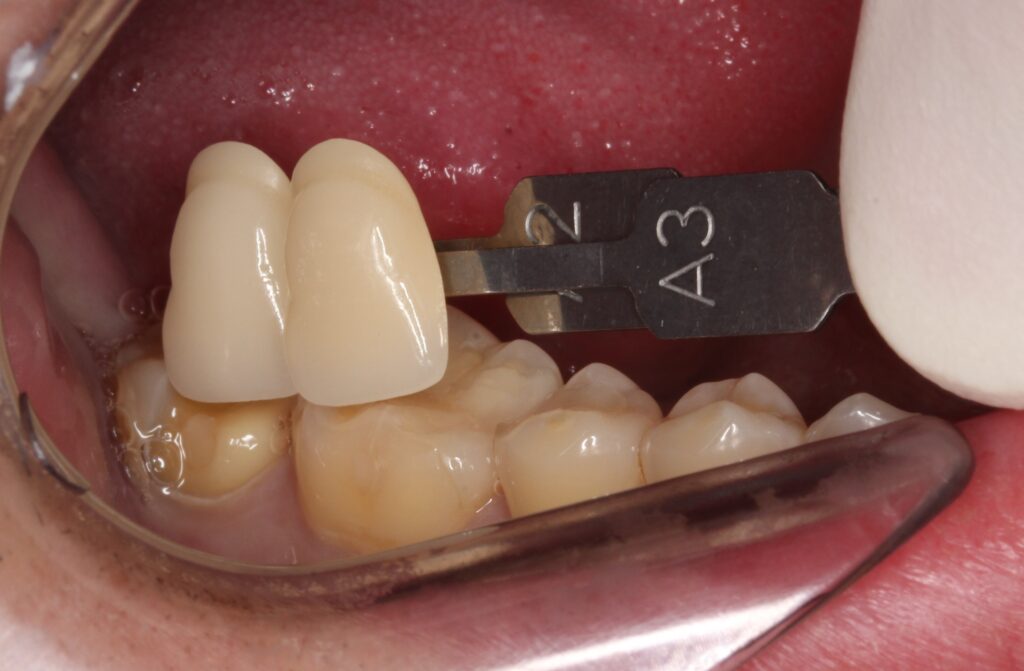 歯の黒い線　虫歯　セラミック　歯医者　自由が丘