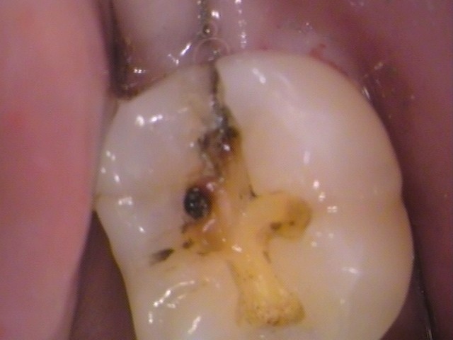 銀歯　虫歯　歯が欠けた　自由が丘　歯医者