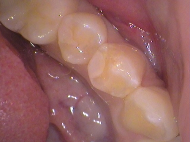 レジン　虫歯　セラミック治療　歯医者　自由が丘