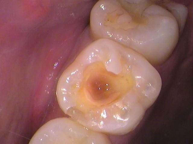 レジン　虫歯　自由が丘　歯医者
