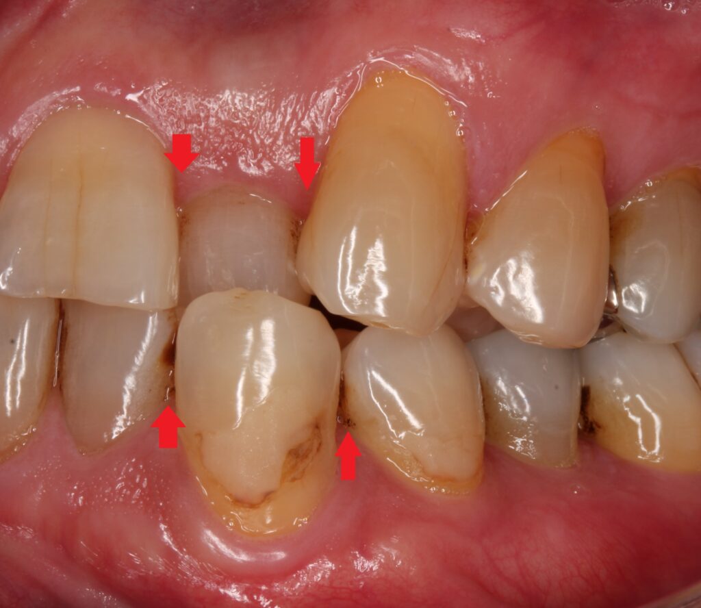 叢生　ガタガタ歯並び　自由が丘　歯医者