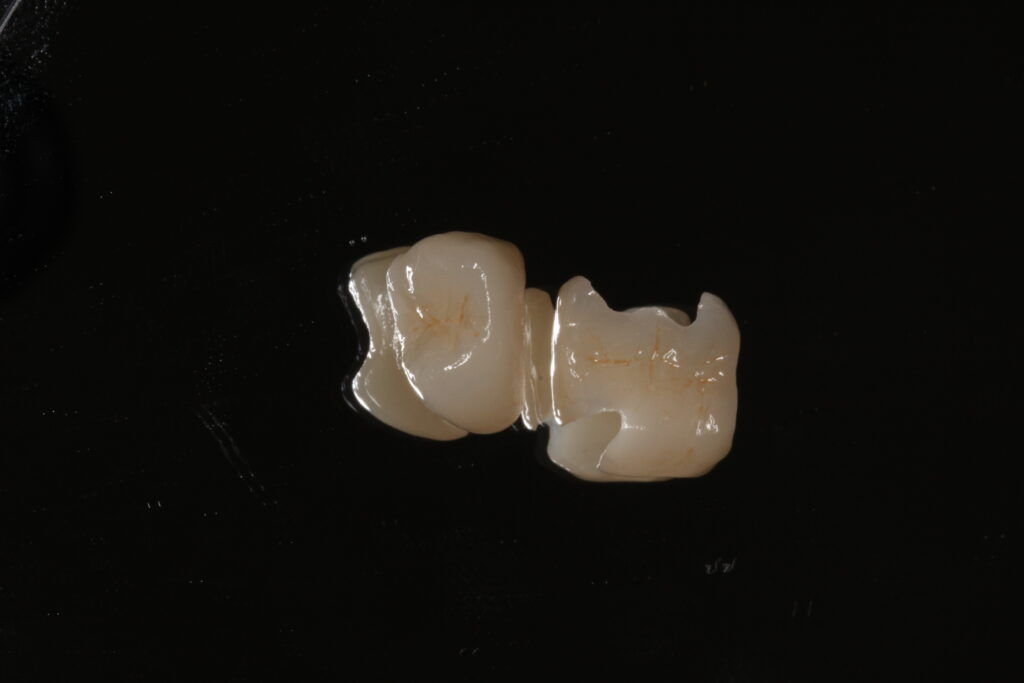 銀歯　セラミック　交換　自由が丘　歯医者　