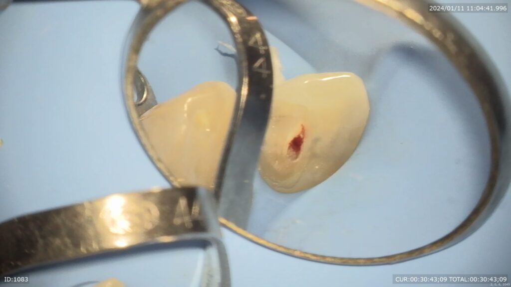 神経温存療法　自由が丘　歯医者