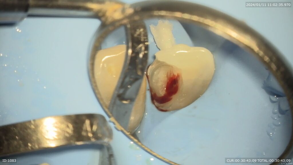 神経温存療法　自由が丘　歯医者