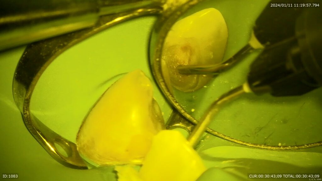 神経温存療法　自由が丘　歯医者