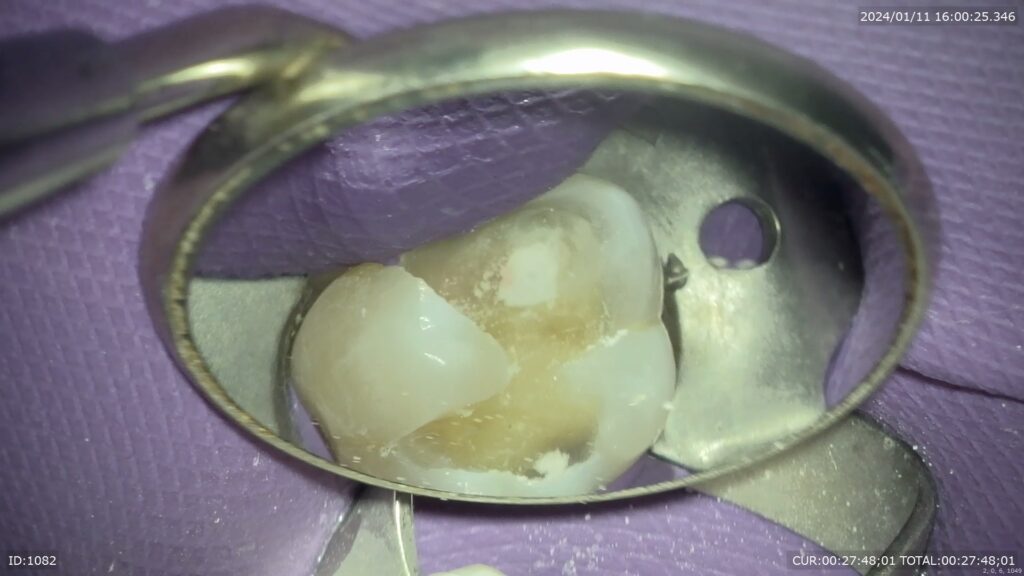 神経温存療法　自由が丘　歯医者