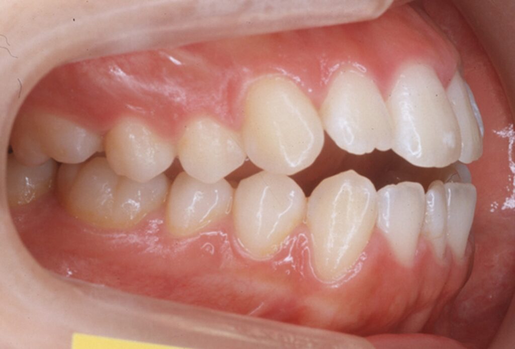 開咬　自由が丘　歯医者