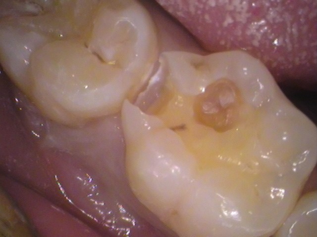 ダイレクトボンディング　虫歯　歯医者　自由が丘