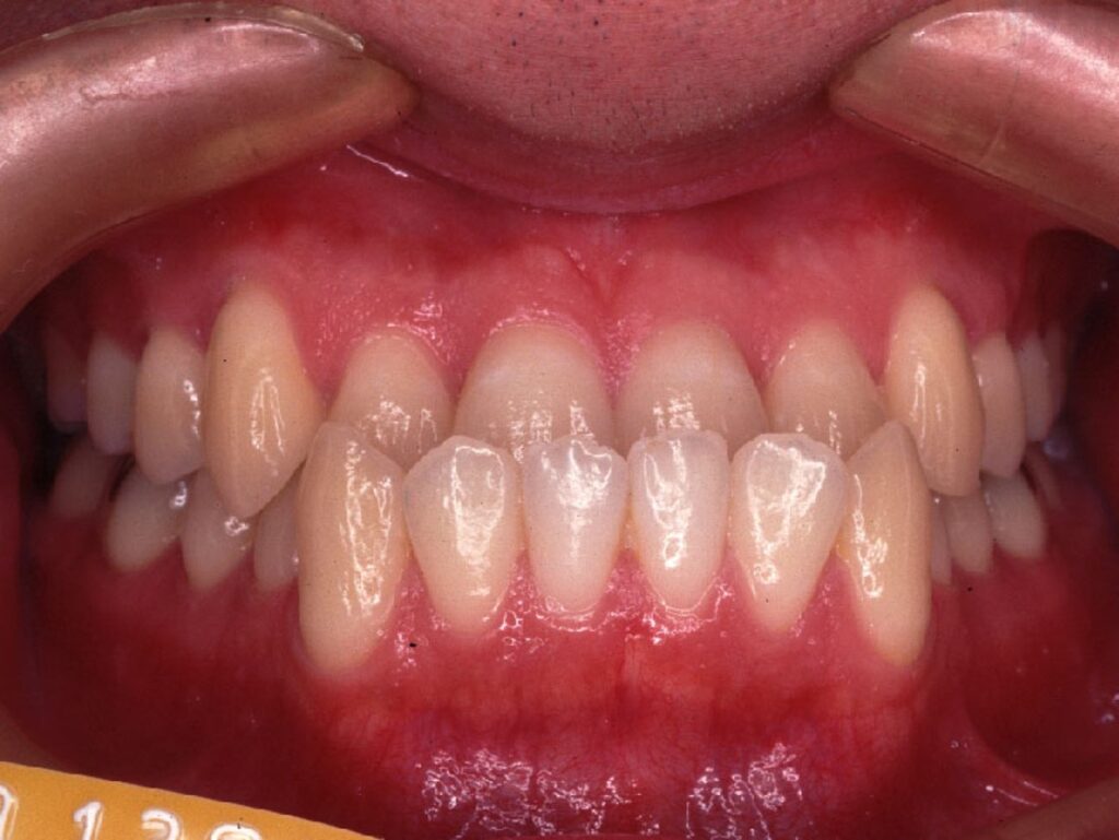 反対咬合　歯医者　虫歯　自由が丘