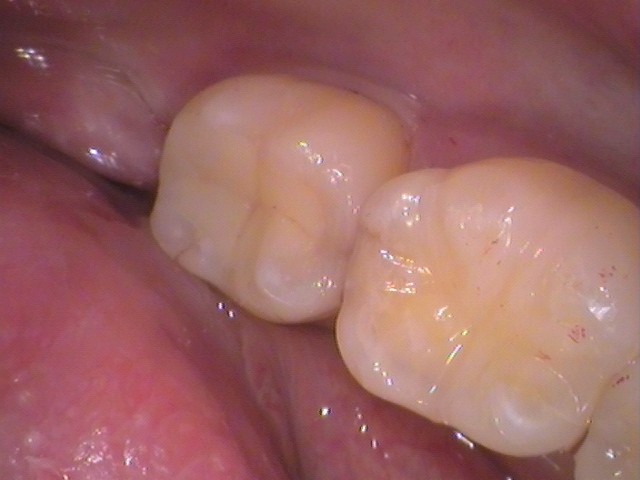 銀歯　虫歯　歯が欠けた　自由が丘　歯医者