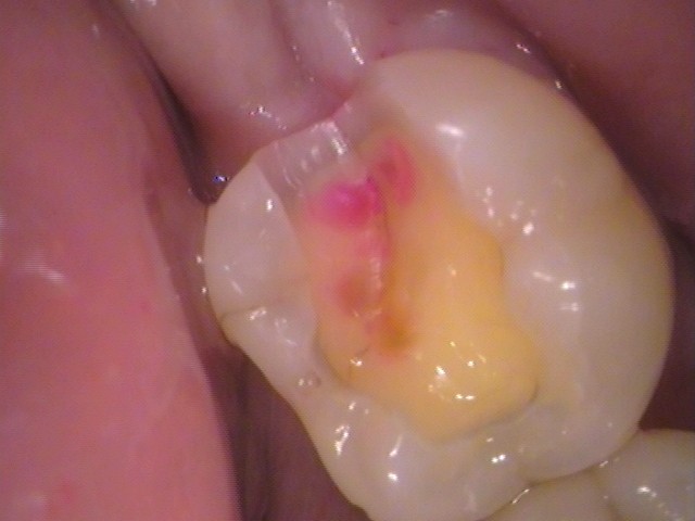 銀歯　虫歯　歯が欠けた　自由が丘　歯医者