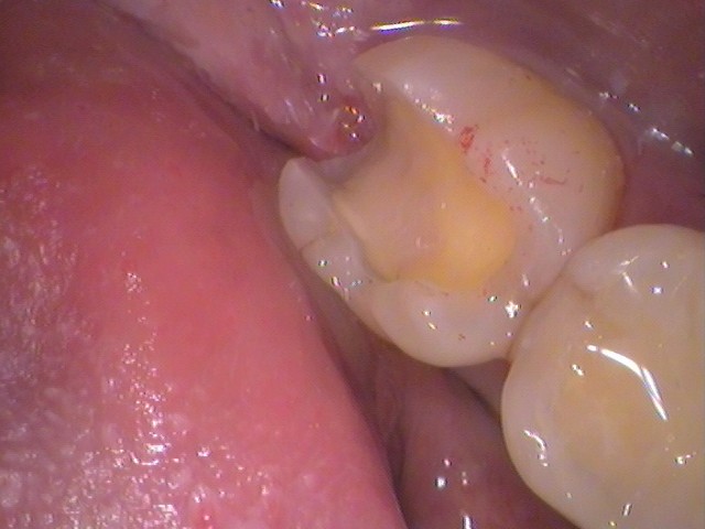 銀歯　虫歯　歯が欠けた　自由が丘　歯医者
