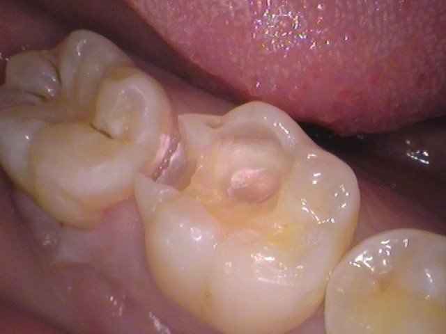 ダイレクトボンディング　虫歯　歯医者　自由が丘