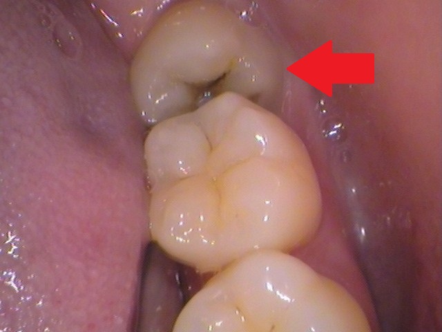親知らず　虫歯　自由が丘　歯医者
