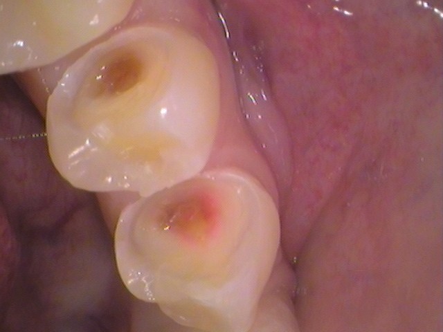 レジン　虫歯　セラミック治療　歯医者　自由が丘