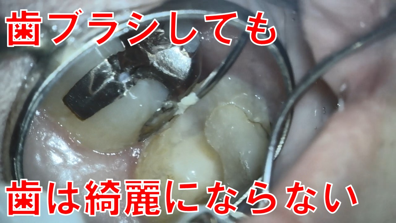 フロス　デンタルフロス　歯のクリーニング　自由が丘　歯医者