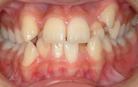 叢生　自由が丘　歯医者