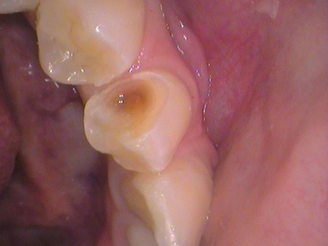 レジン　虫歯　セラミック治療　歯医者　自由が丘