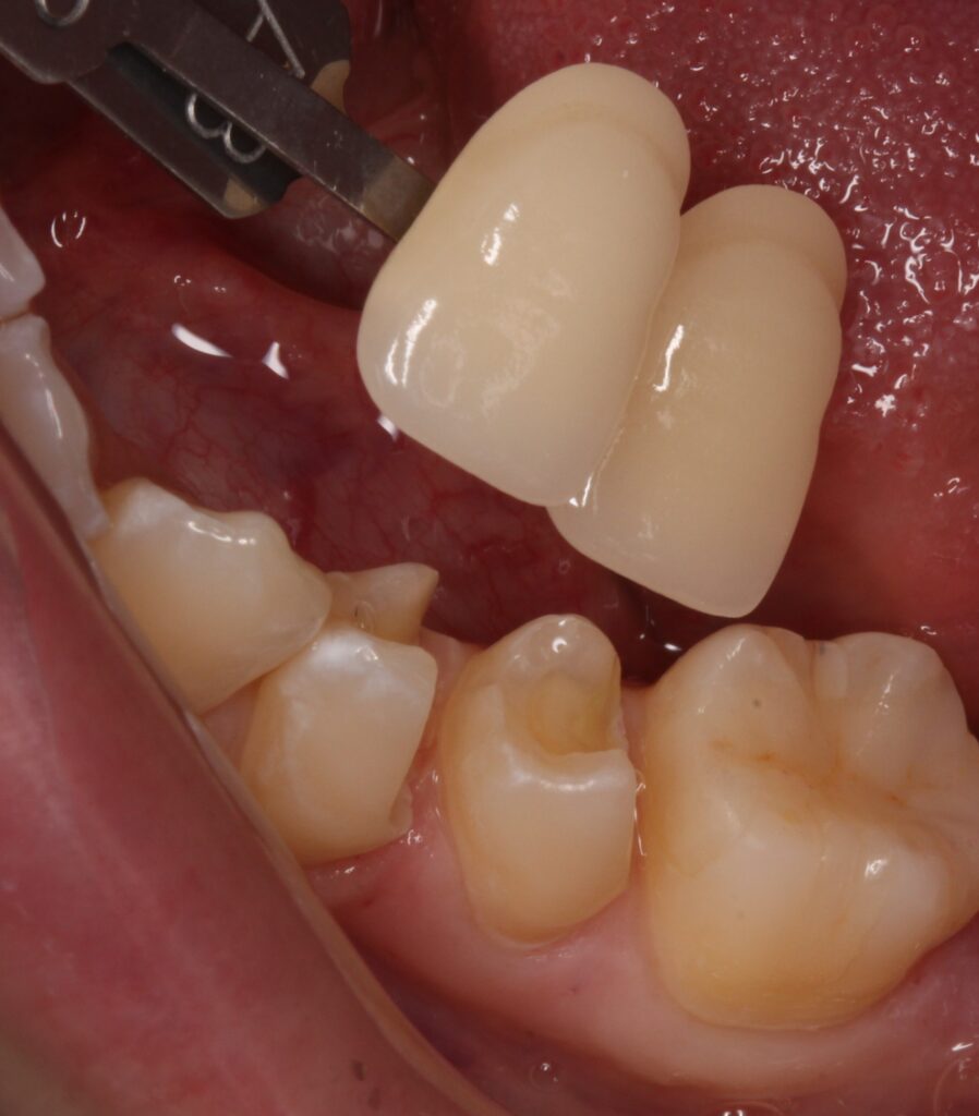 レジン　虫歯　セラミック治療　歯医者　自由が丘