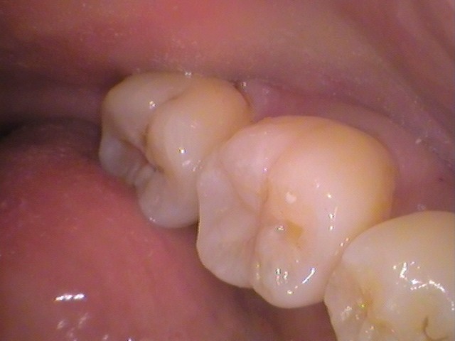 ダイレクトボンディング　レジン　虫歯　自由が丘　歯医者