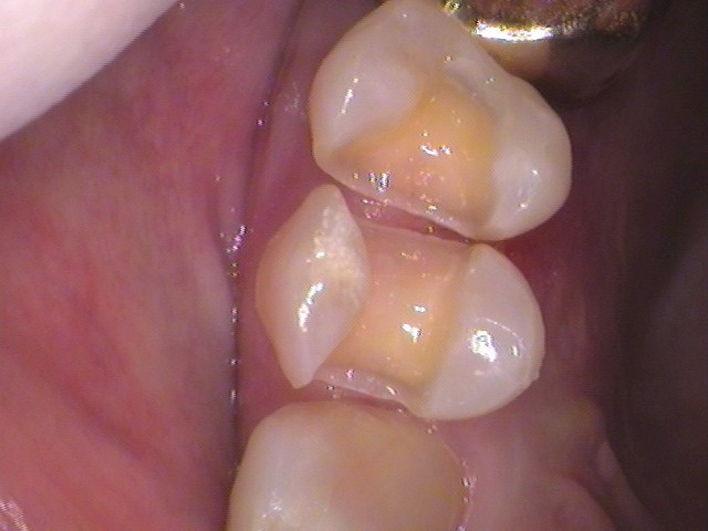 銀歯外れた　虫歯　セラミック　自由が丘　歯医者