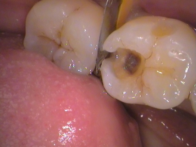 ダイレクトボンディング　レジン　虫歯　自由が丘　歯医者