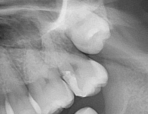 ドックスベストセメント　失敗　予後　虫歯　自由が丘　歯医者