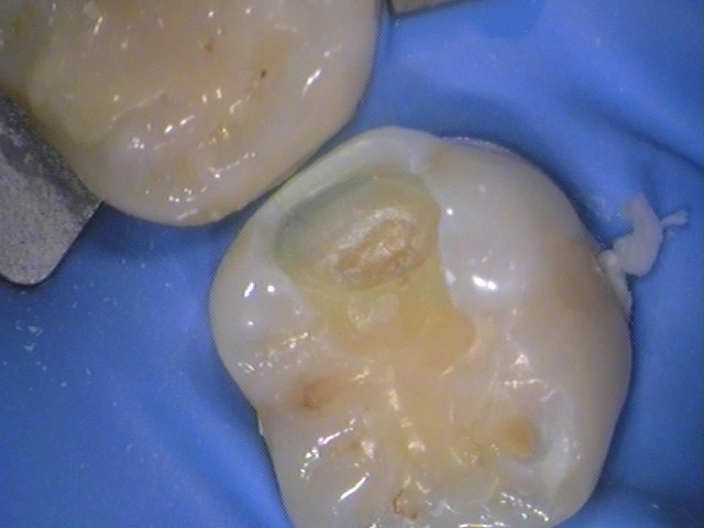 レジン　虫歯　セラミック治療　自由が丘　歯医者