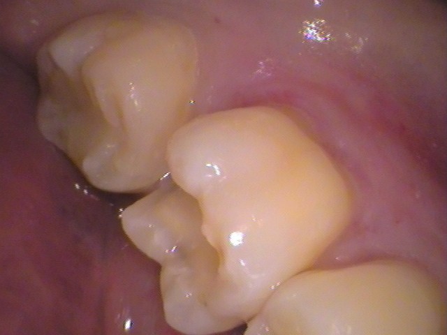 レジン　虫歯　セラミック治療　自由が丘　歯医者