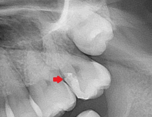 ドックスベストセメント　失敗　予後　虫歯　自由が丘　歯医者