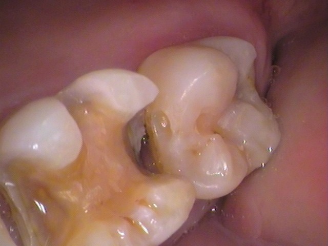 ゴールドインレー　金合金　白金加金　自由が丘　歯医者