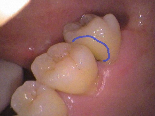 ドックスベストセメント　失敗　予後　虫歯　自由が丘　歯医者