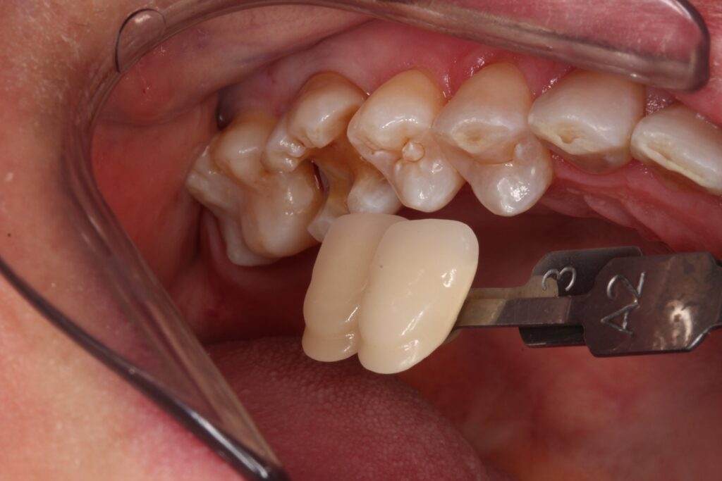 ゴールドインレー　金合金　白金加金　自由が丘　歯医者