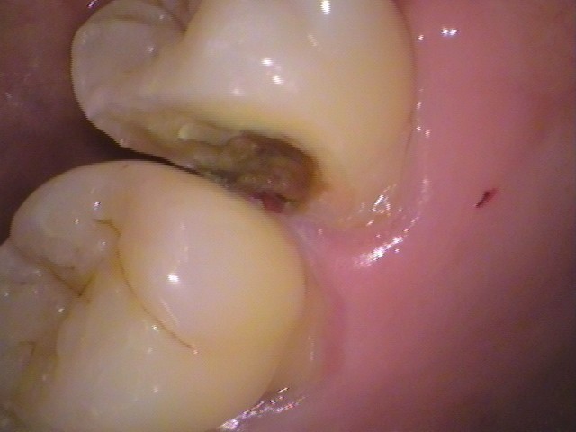 ドックスベストセメント　失敗　予後　虫歯　自由が丘　歯医者