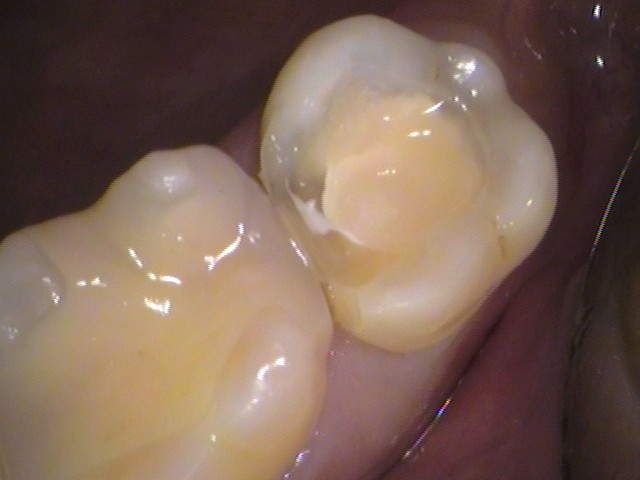 詰め物の下の虫歯　セラミック　自由が丘　歯医者
