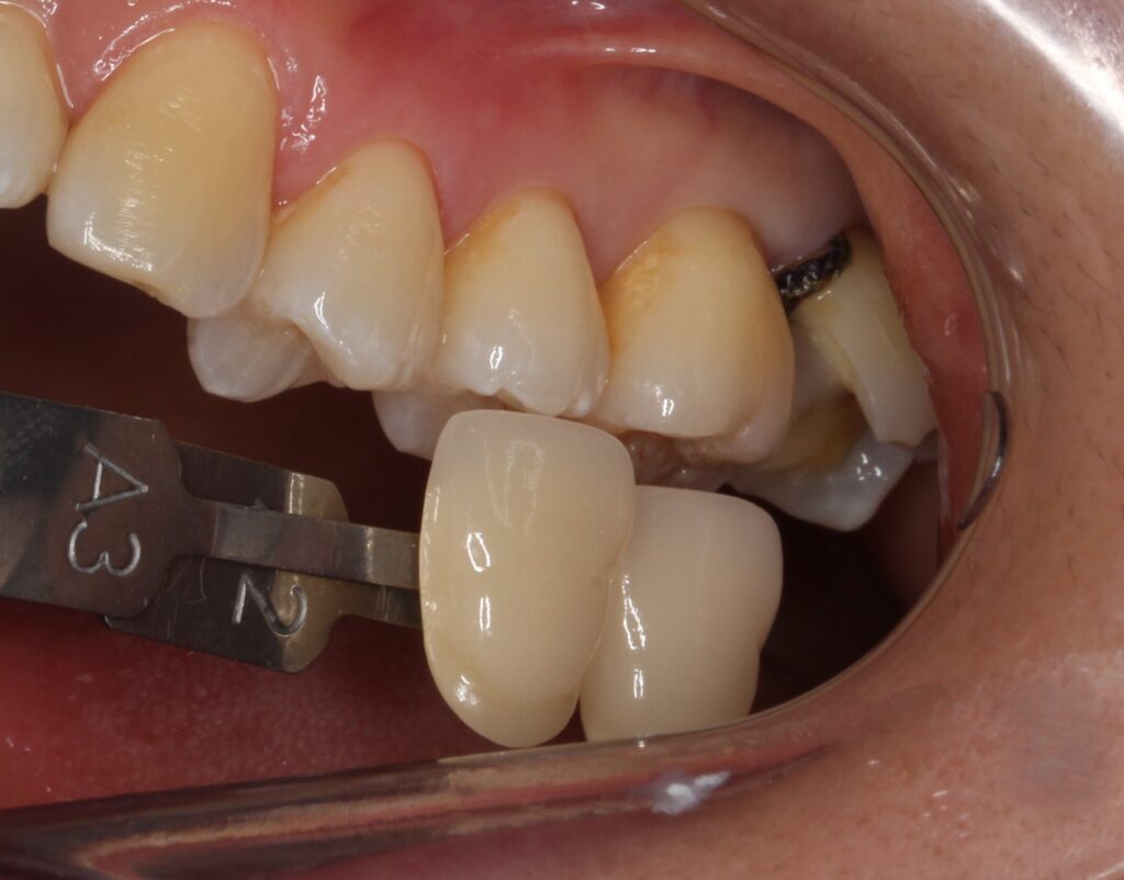 ドックスベストセメント　失敗　予後　虫歯　自由が丘　歯医者