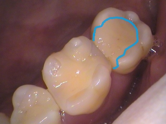 詰め物の下の虫歯　セラミック　自由が丘　歯医者